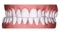 Dental implants in London