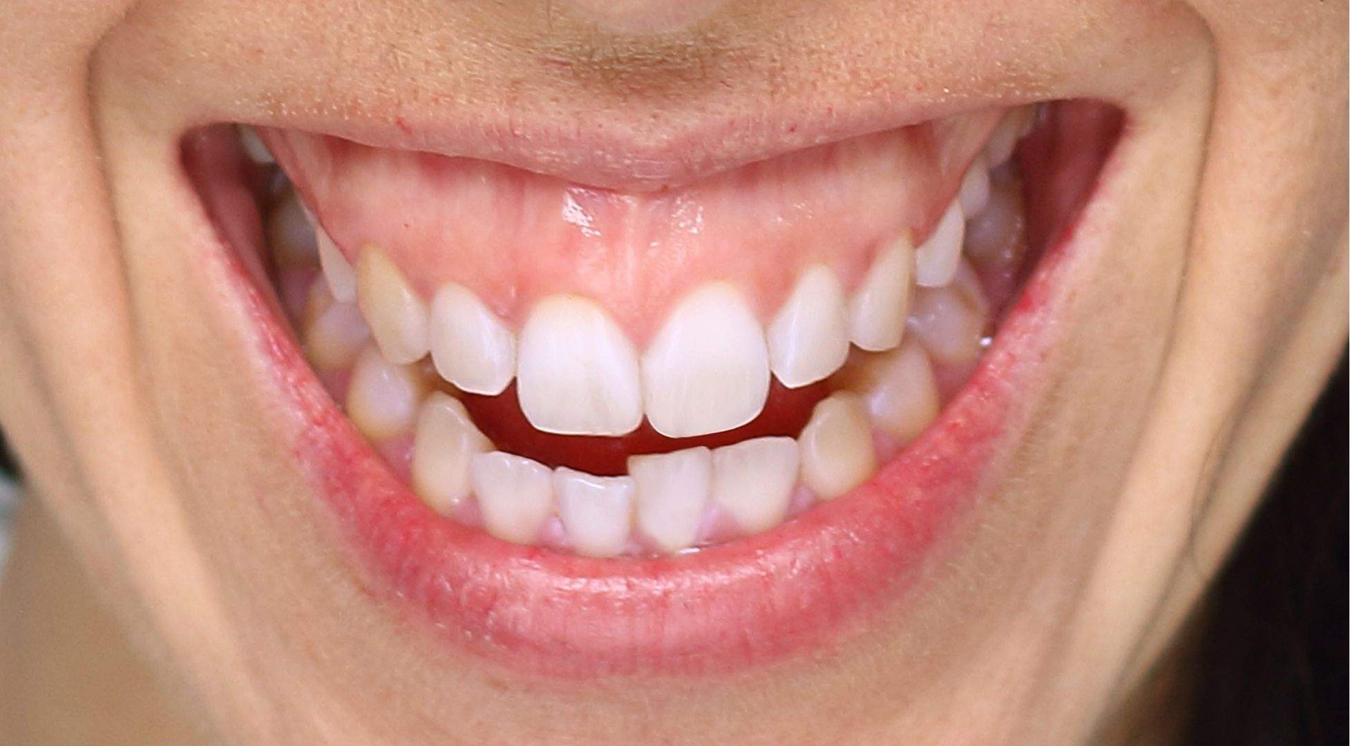 Banish Your Gummy Smile The Botox Solution You Never Knew You Needed