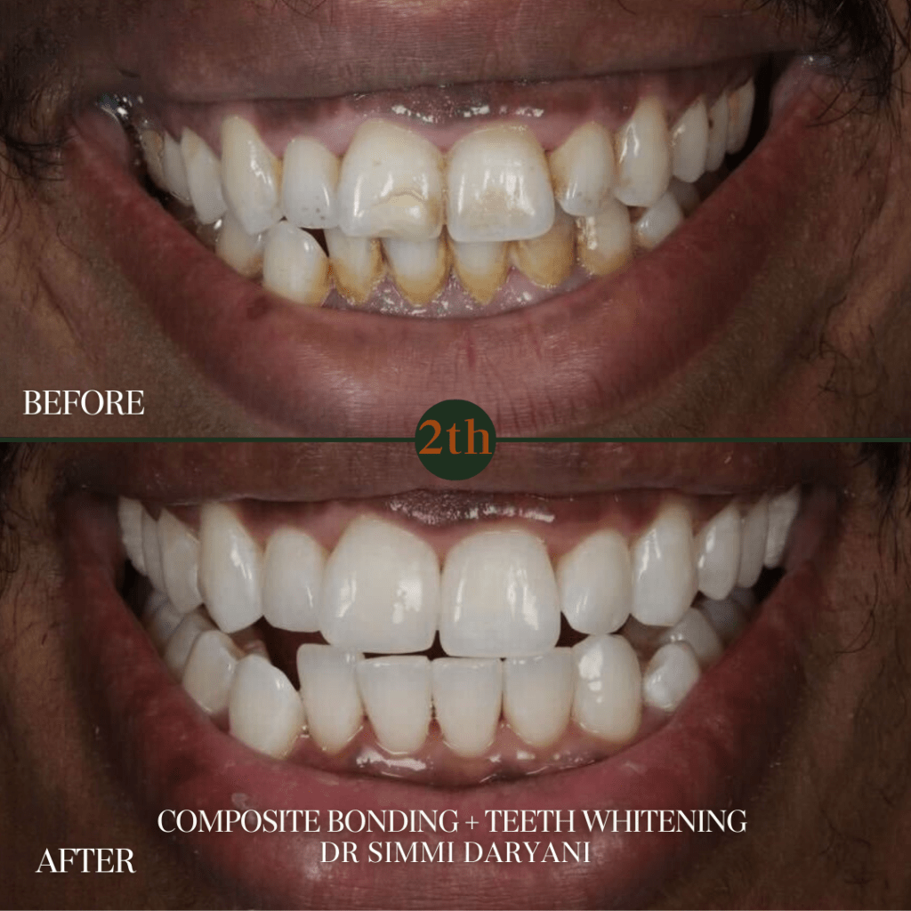Composite bonding + Teeth whitening