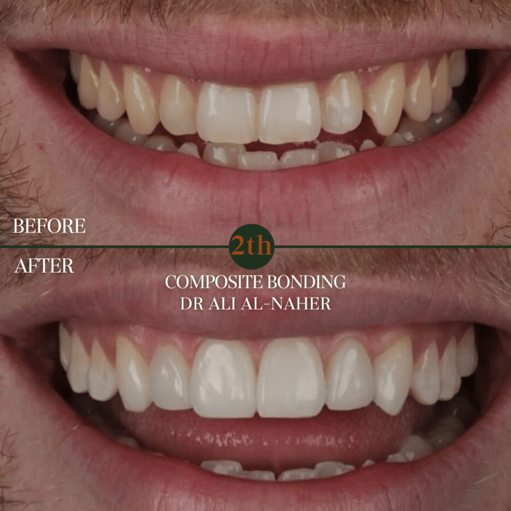 Composite Bonding before and after
