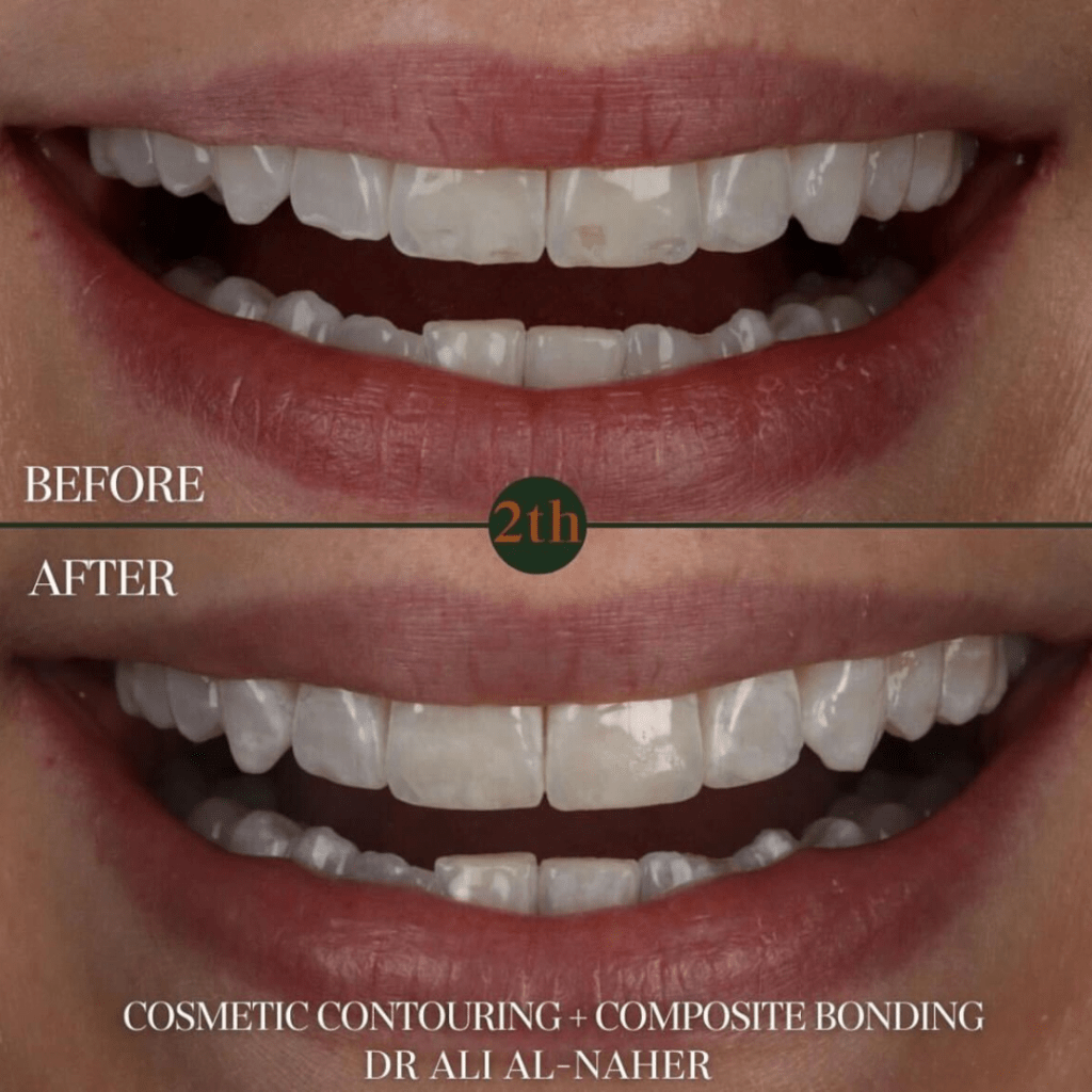 Cosmetic Contouring + Composite Bonding before and after