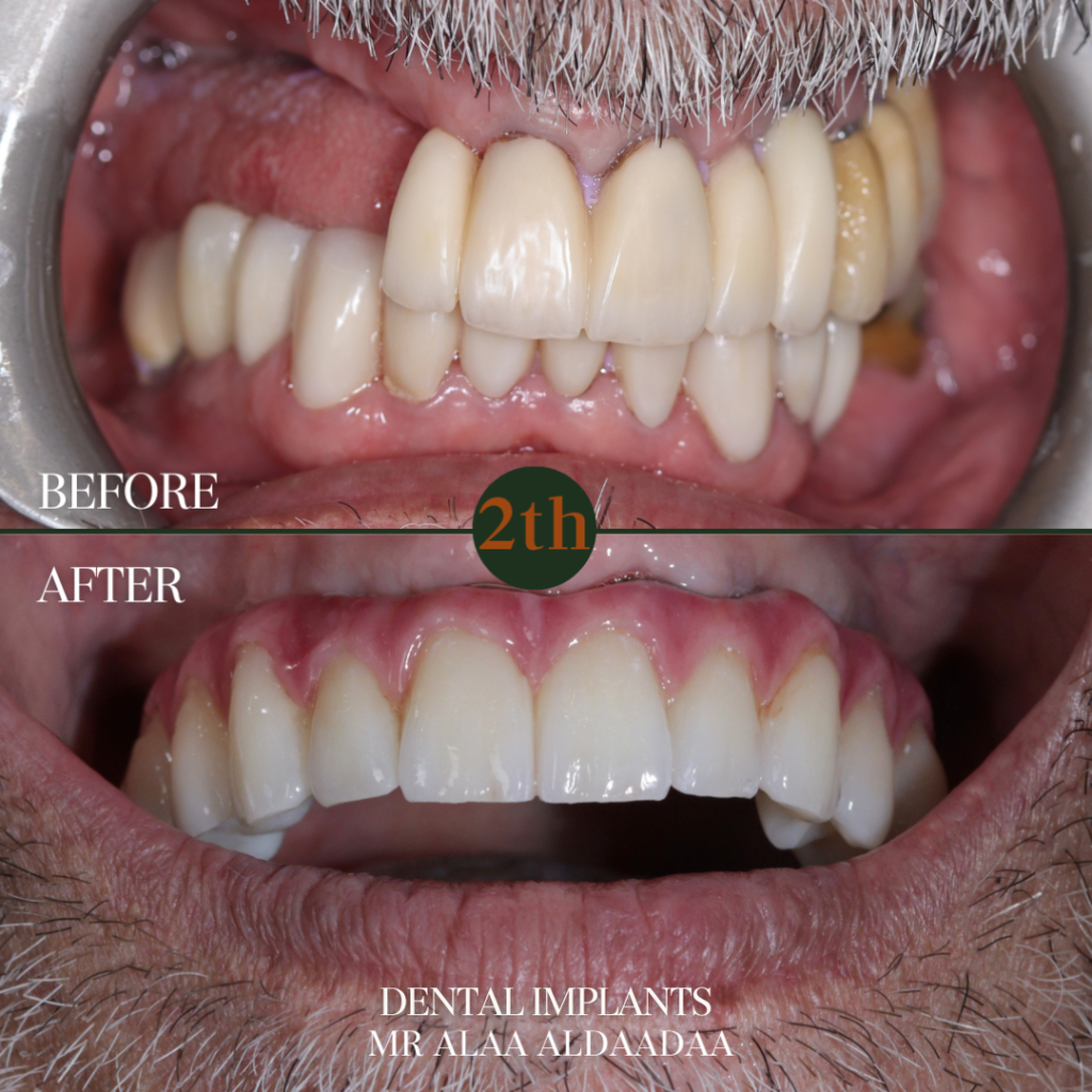 Dental Implants before and after