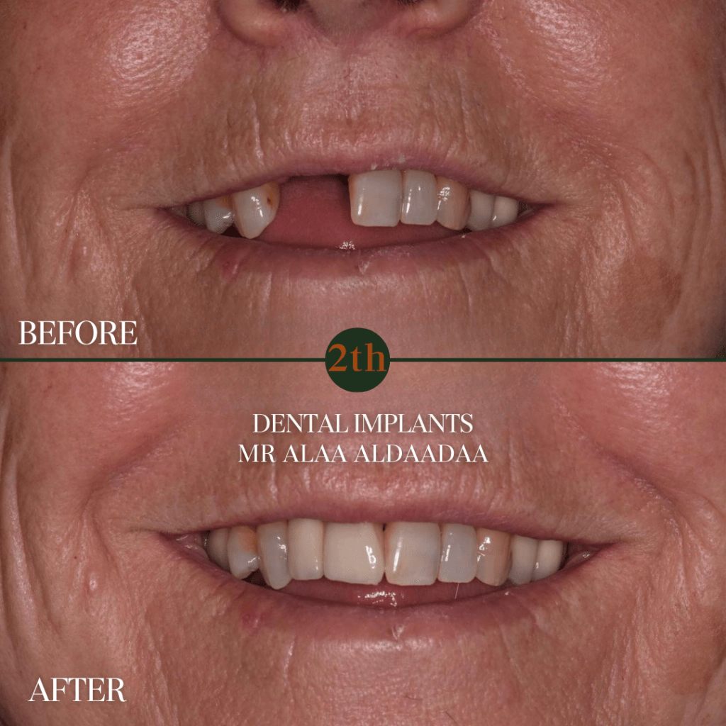 Dental Implants before and after