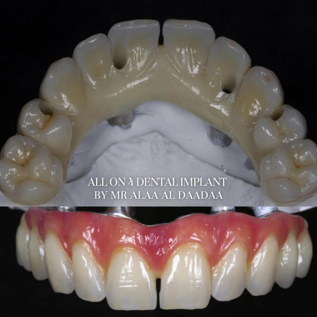 Dental Implants All on 4