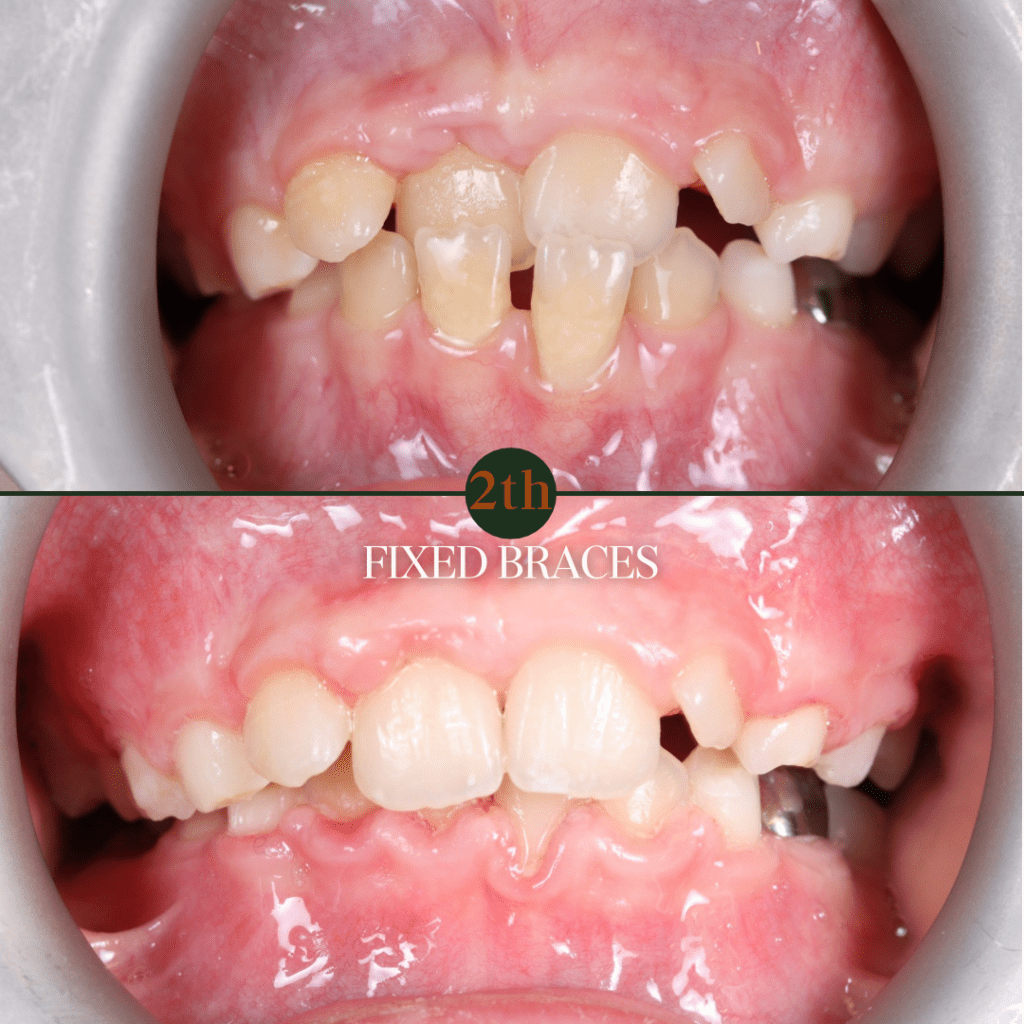 Fixed braces before and after