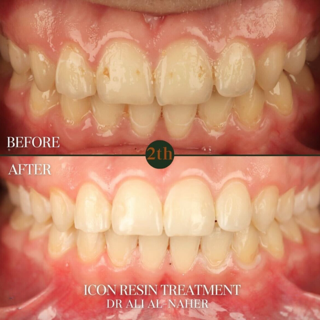 Icon Resin Treatment before and after