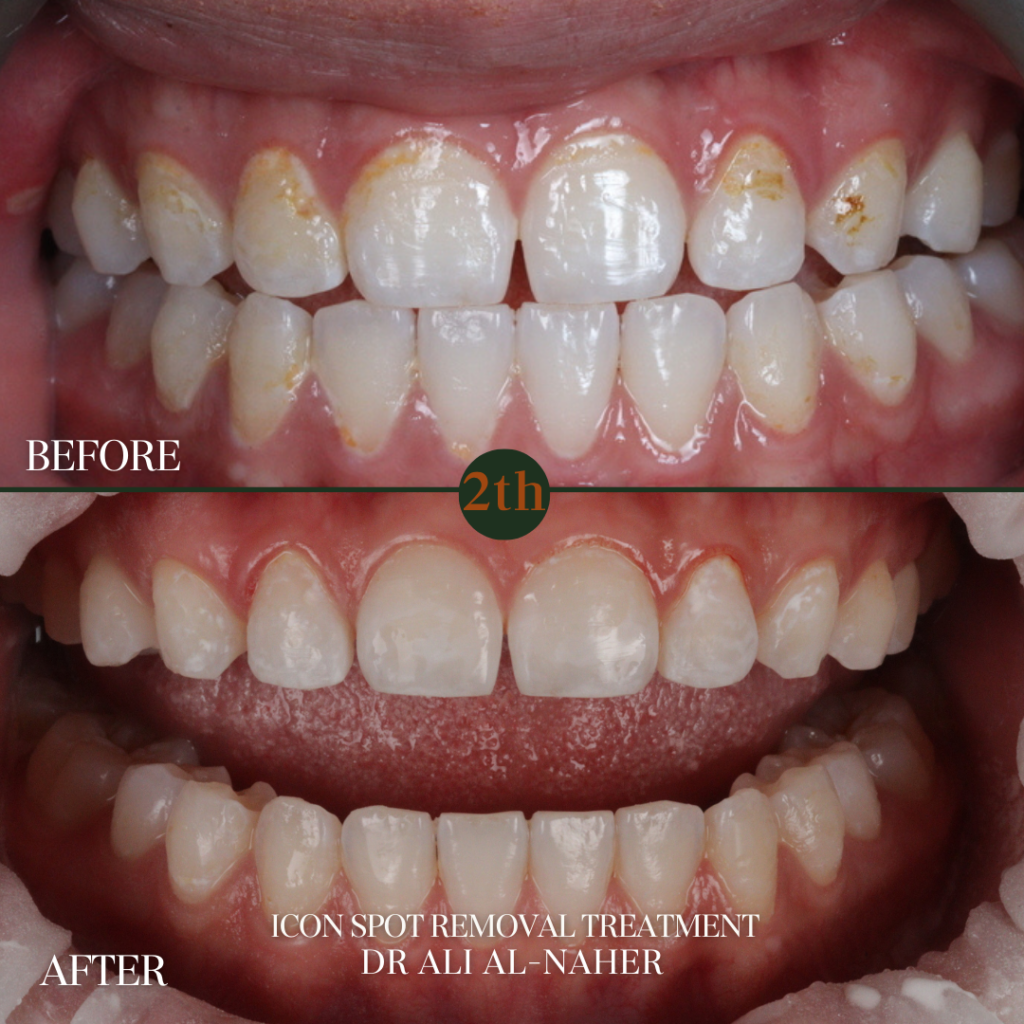 Icon Sport Removal treatment before and after