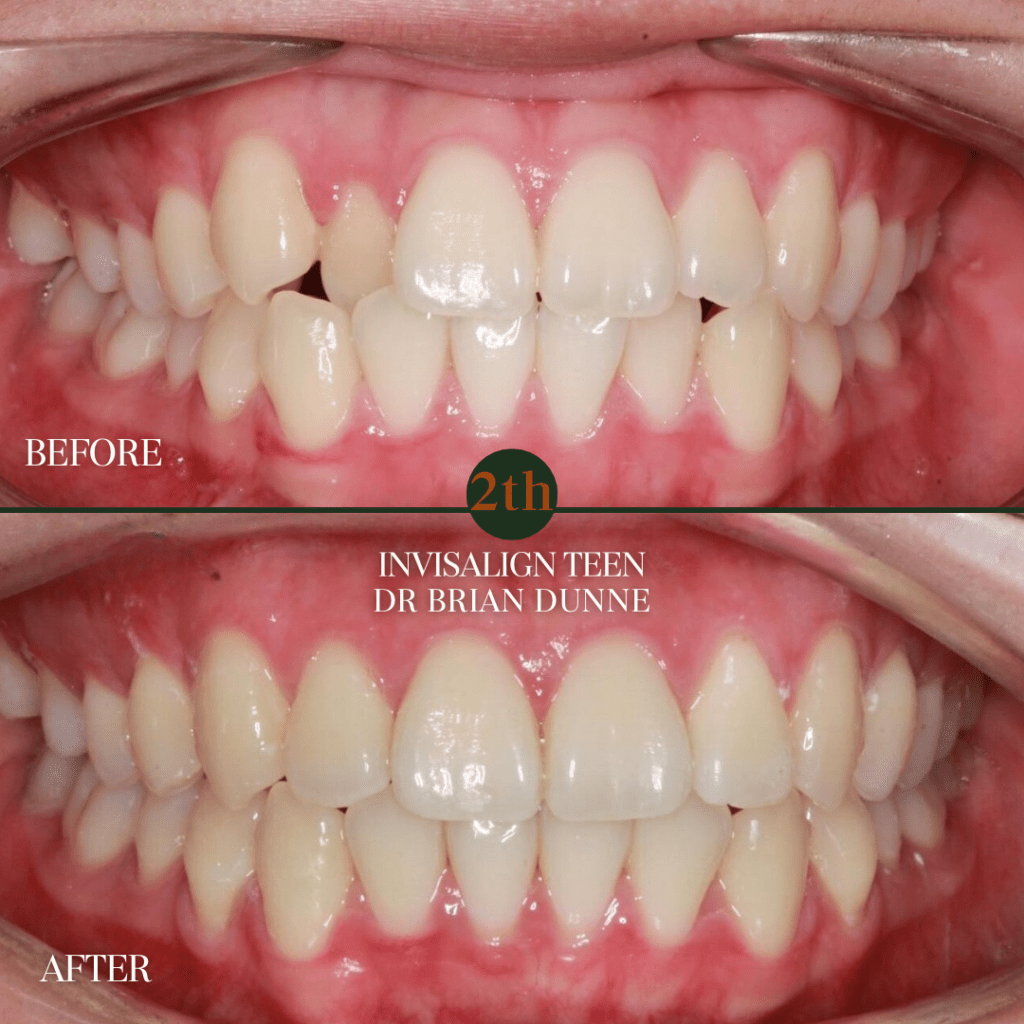 Invisalign Teen before and after
