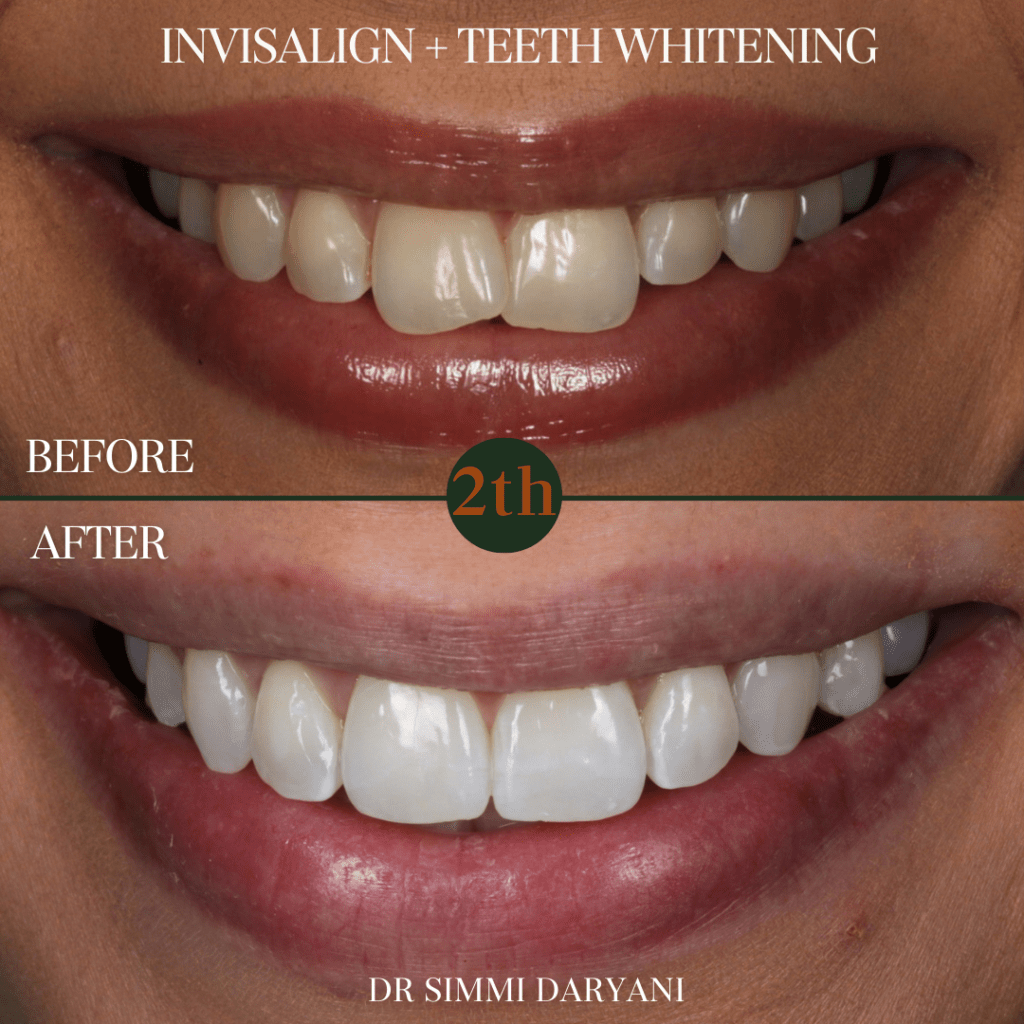 Invisalign + Teeth whitening before and after